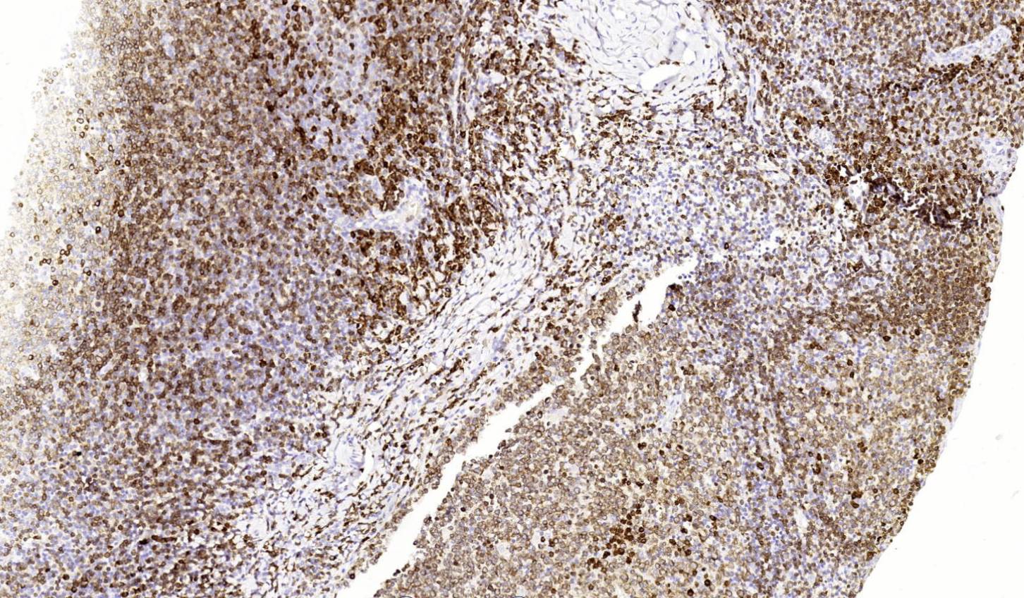 14 - CD79a AD80015