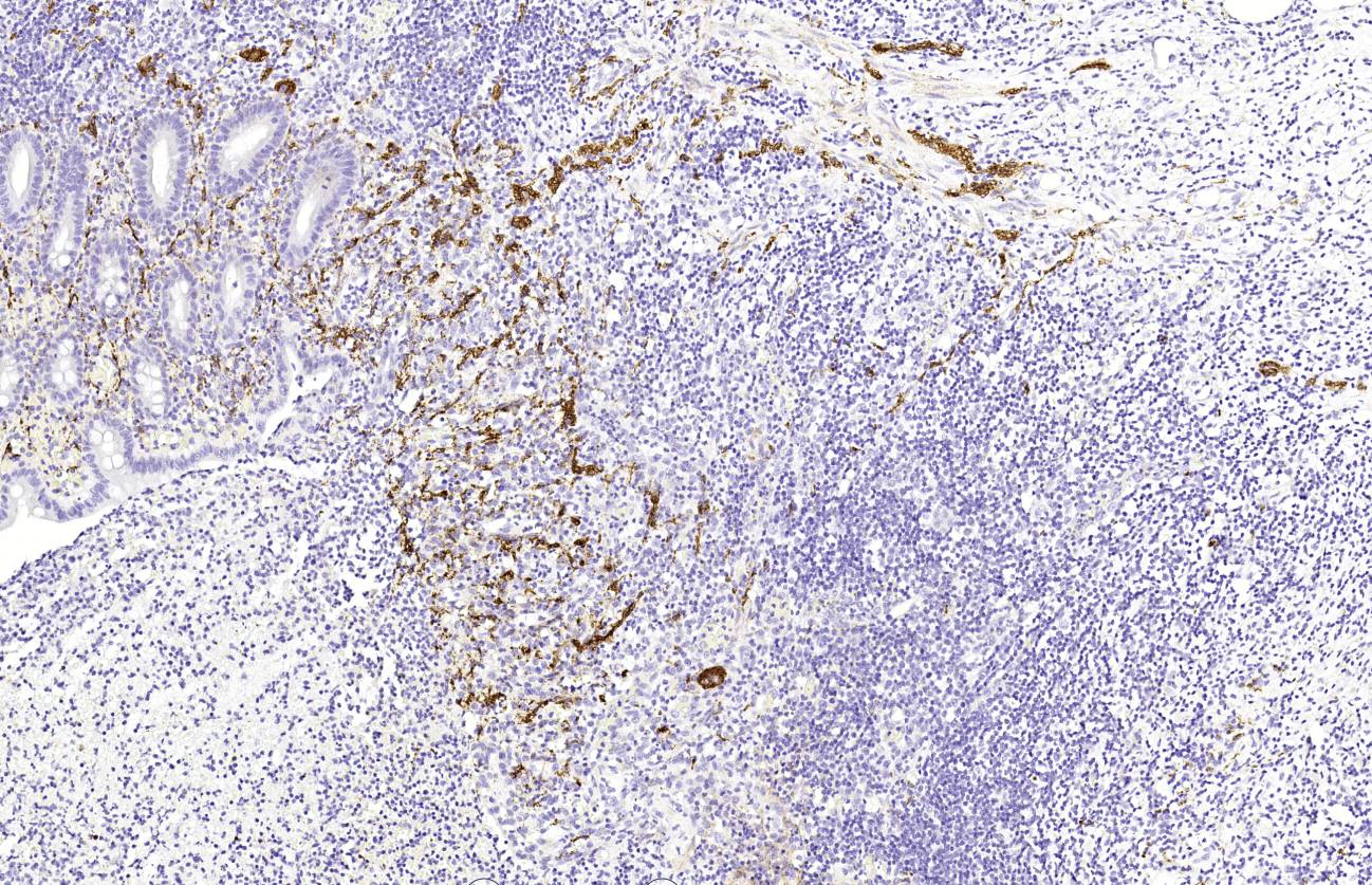 14 - CD56 AD80211