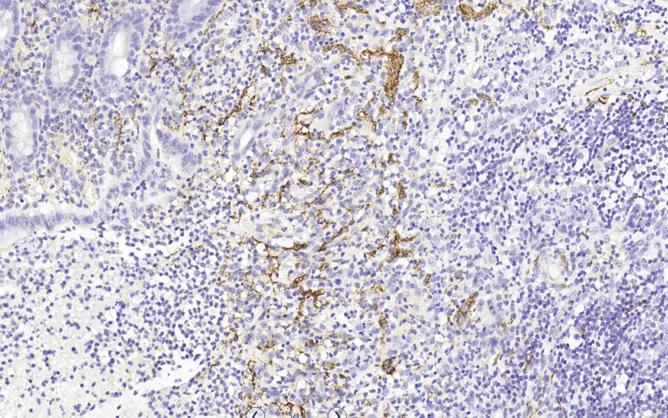 14 - CD56 AD80211