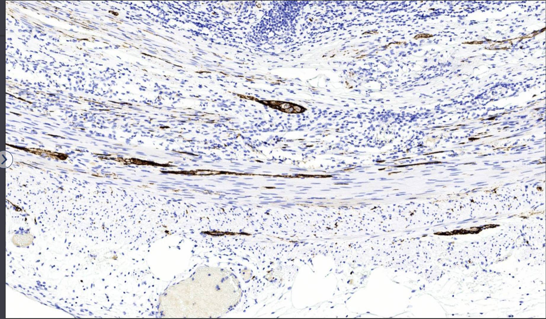 14 - CD56 AD80211
