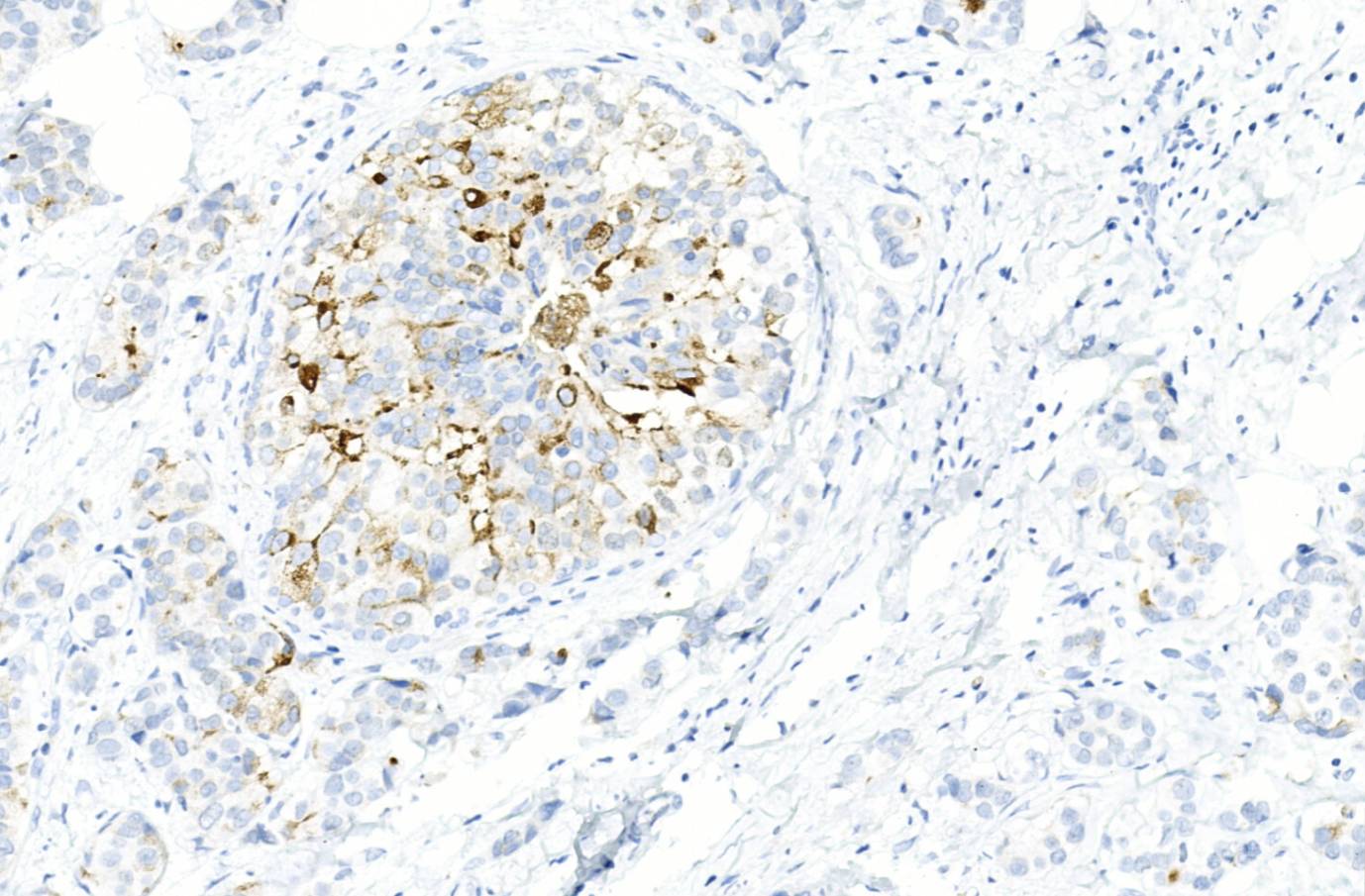14 - GCDFP-15 AD80264