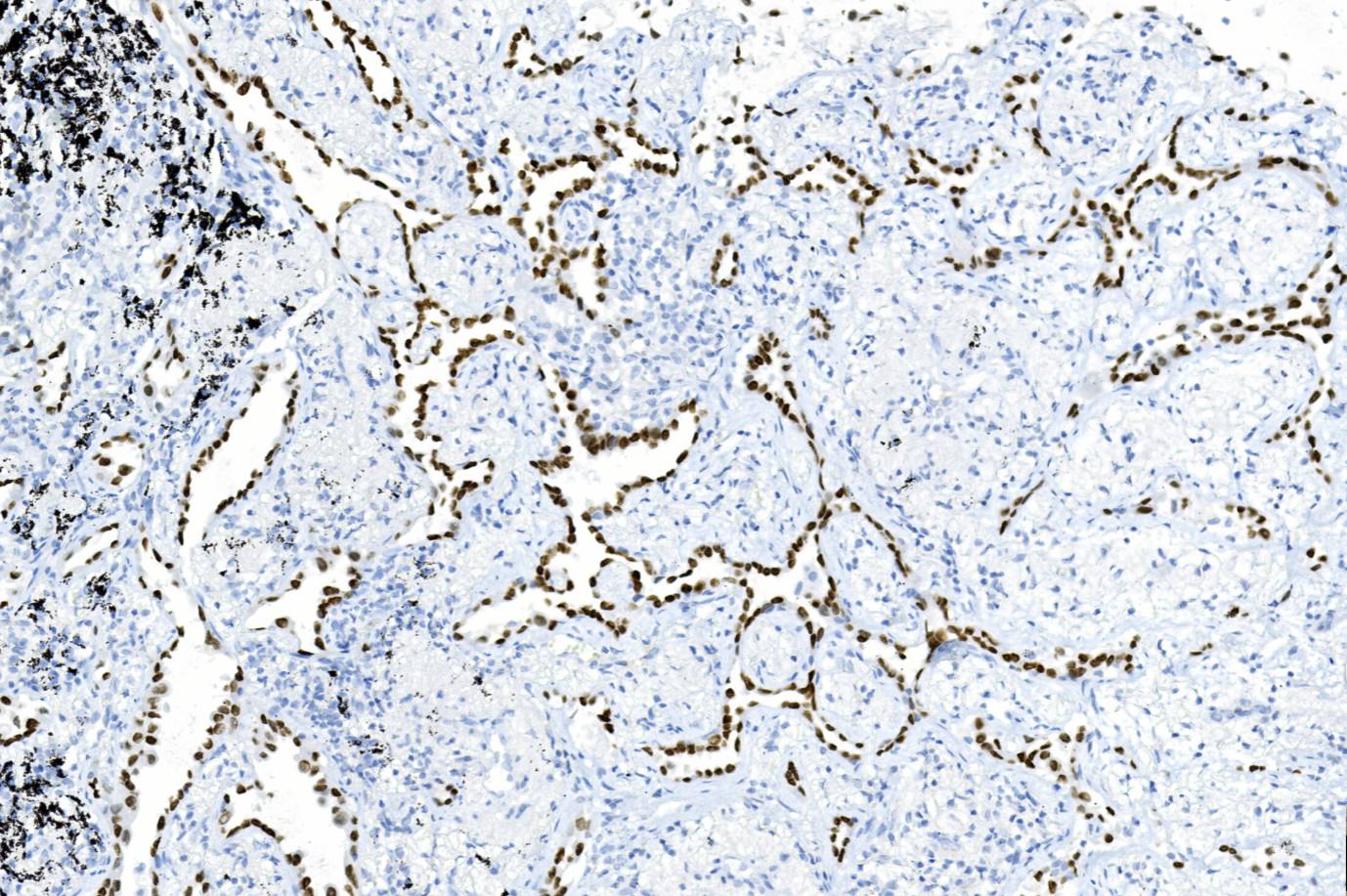 14 - HNF1-Beta AD80341