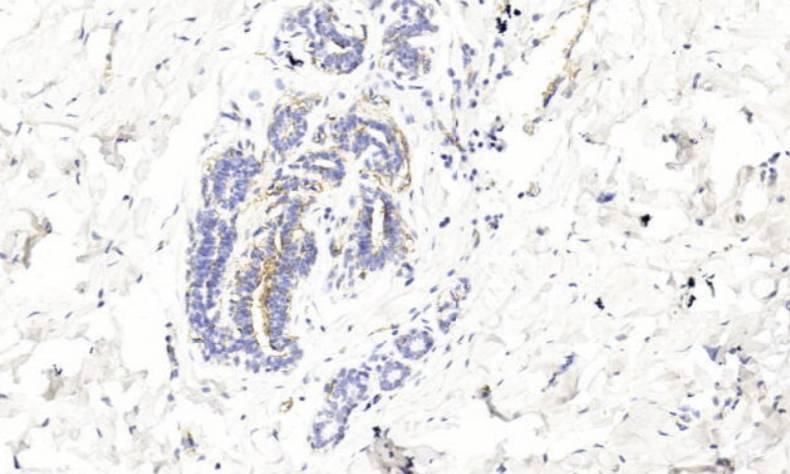 14 - MC、Mesothelioma AD80343
