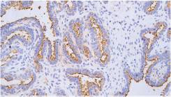 14 - MC、Mesothelioma AD80343