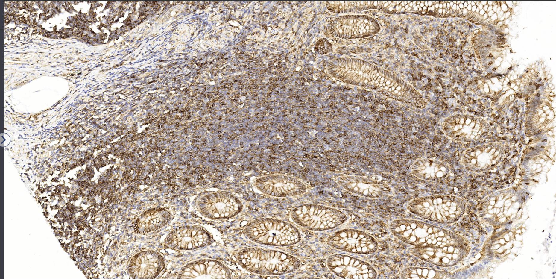 14 - CD99 AD80452