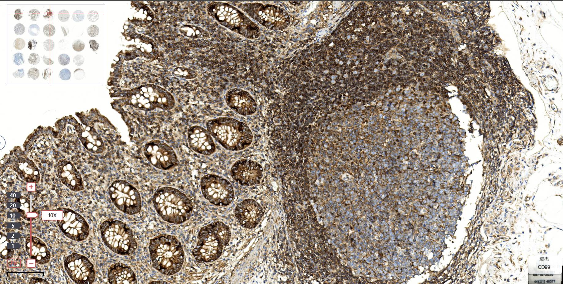14 - CD99 AD80452