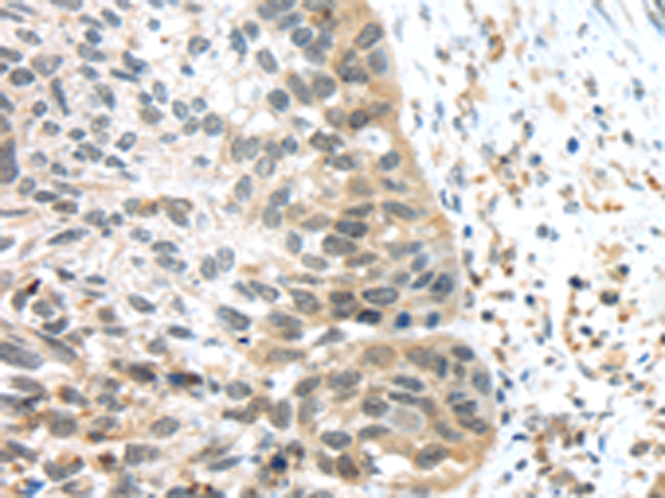 2 - The image is immunohistochemistry of paraffin-embedded Human esophagus cancer tissue using P12340(TS AO2751a